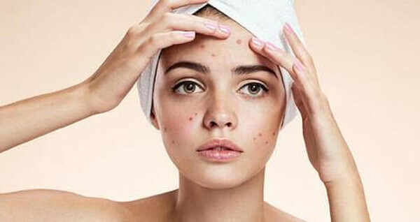 Acne, it’s more than just hormones Sherwood Park