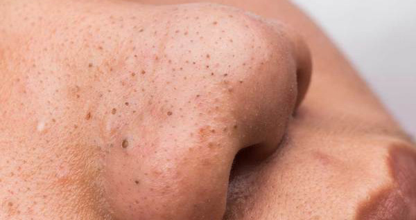 Blackheads - Causes and Treatments Sherwood Park